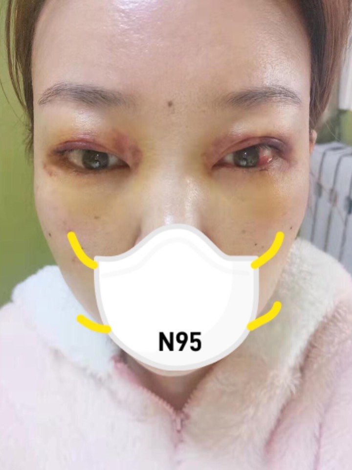 眼袋手术后的第五天!