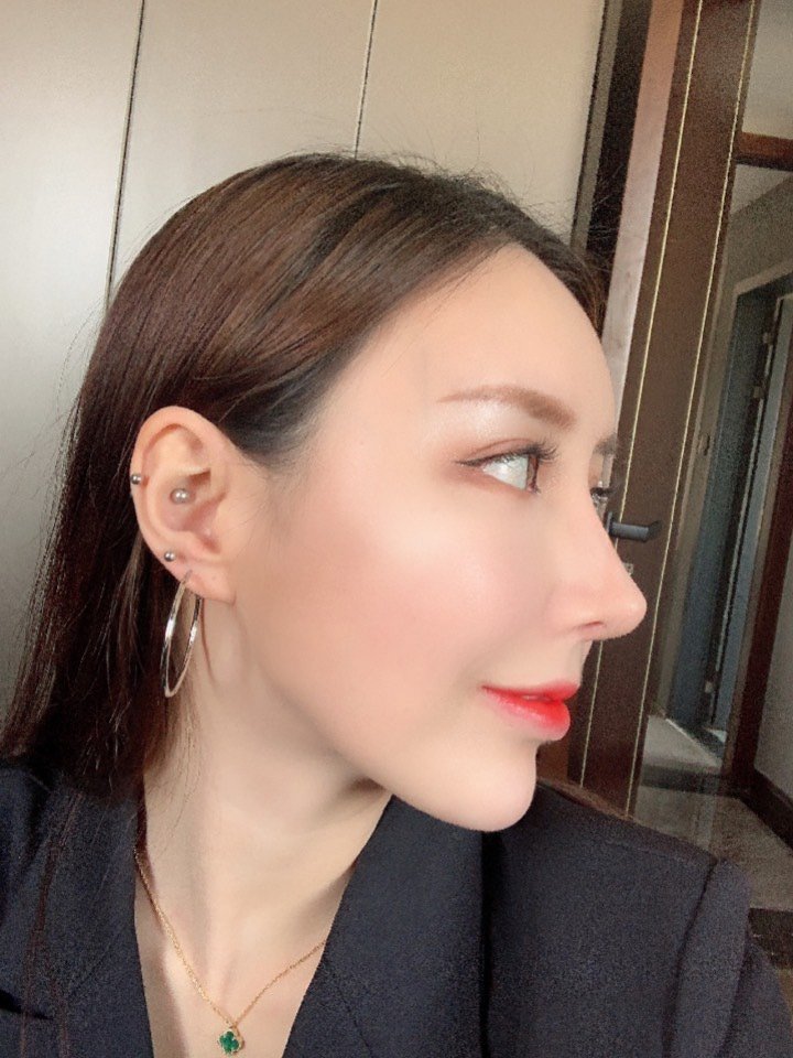 肋骨鼻 #隆鼻修复 自体肋骨鼻第二次修复,这次终_圈子-新氧美容整形