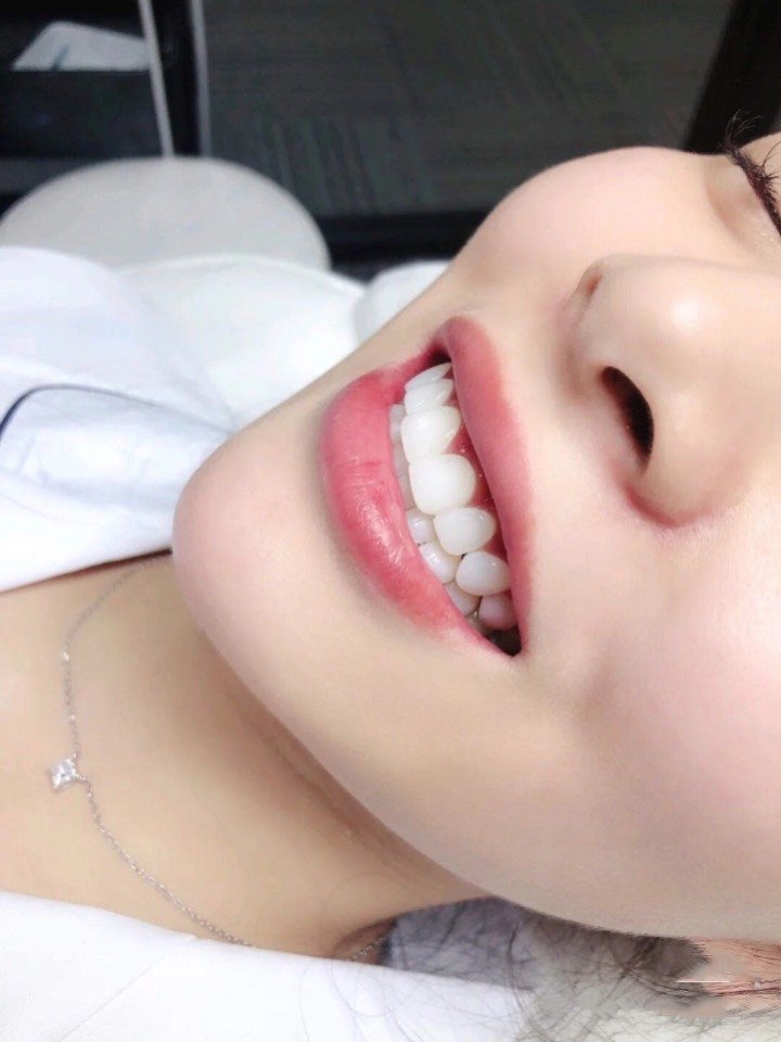 牙齿整齐好看整个人的气质和自信都提上去了,在菲澜口_圈子-新氧美容