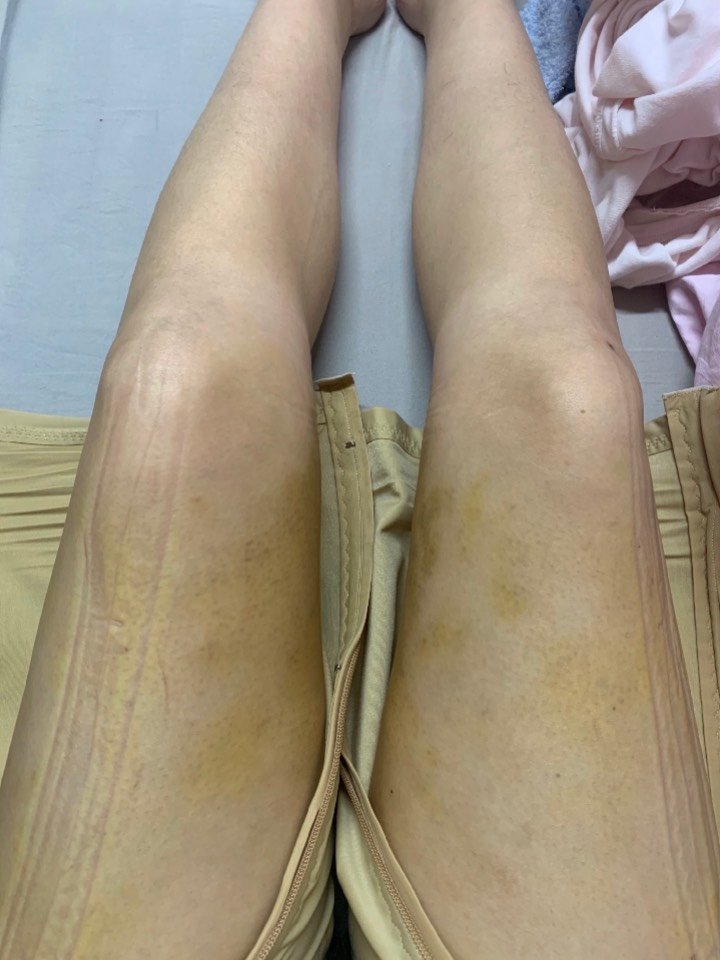 大腿环吸术后第7天走不还是有点疼