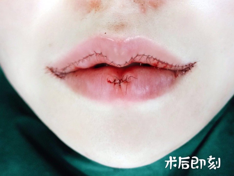 人中缩短 微笑唇来袭,犹犹豫豫,终于还是做了