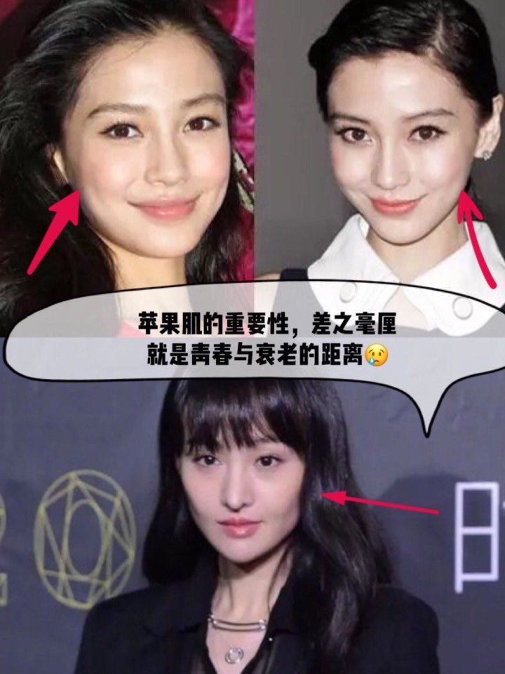 是构成"心形脸"的重要元素,大部分人的衰老,就是从苹果肌下垂开始的