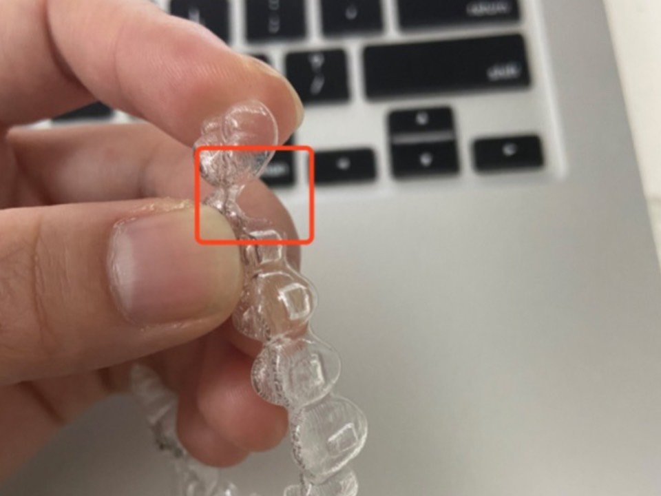 在带上牙套几个月后,我终于迎来了我的牙套橡皮筋!