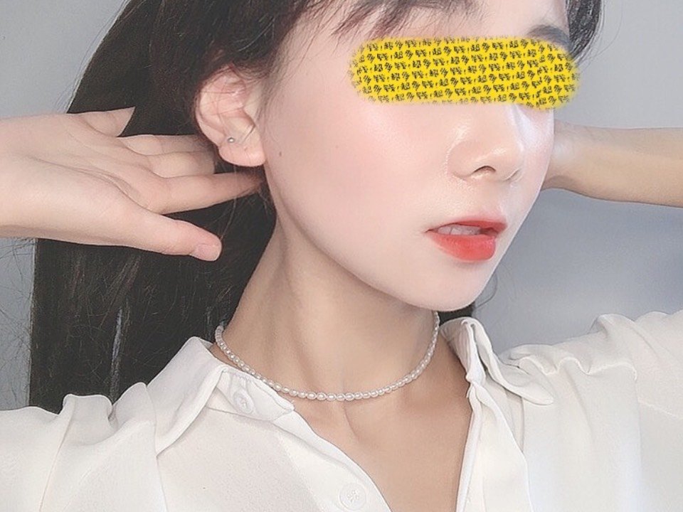 硅胶垫下巴私信领红包上门礼韩式生科假体丰下巴进口假体改善短下巴嘴