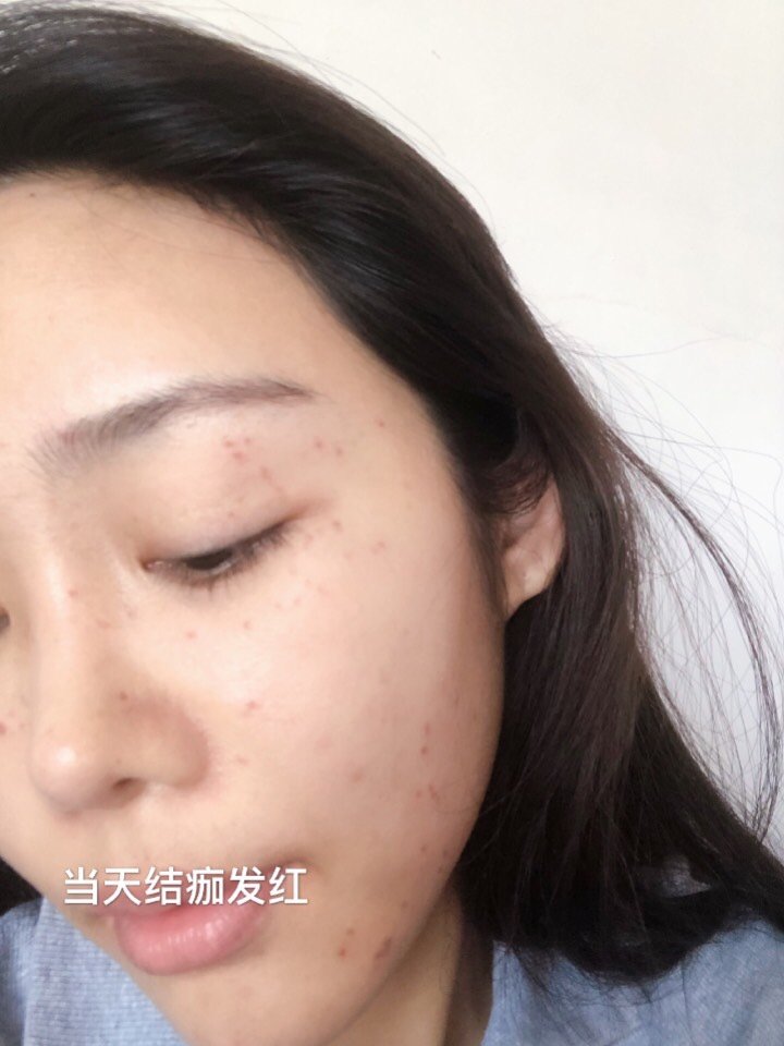 超皮秒术后恢复期记录 | 第三天