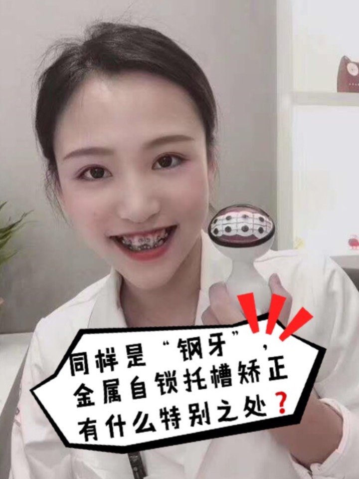 01同样是钢牙金属自锁托槽矫正有什么特别之处