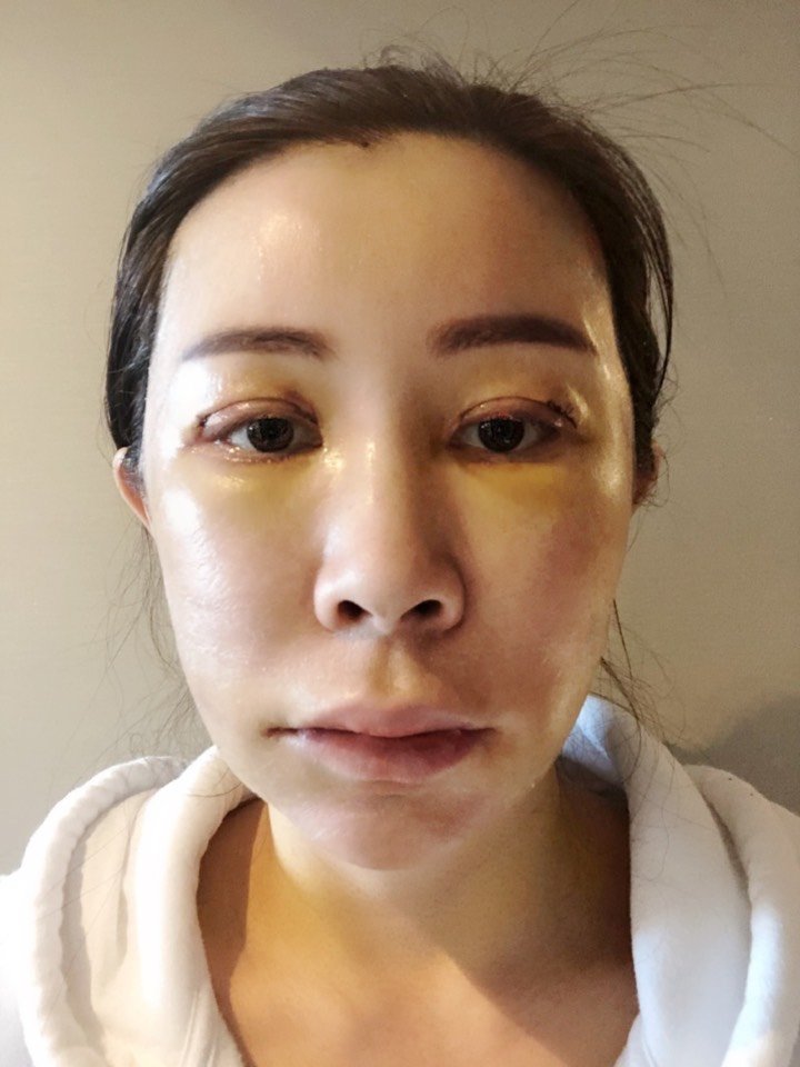 [轮廓77面部脂肪填充77双眼皮修复77开眼角术后第二天_圈子