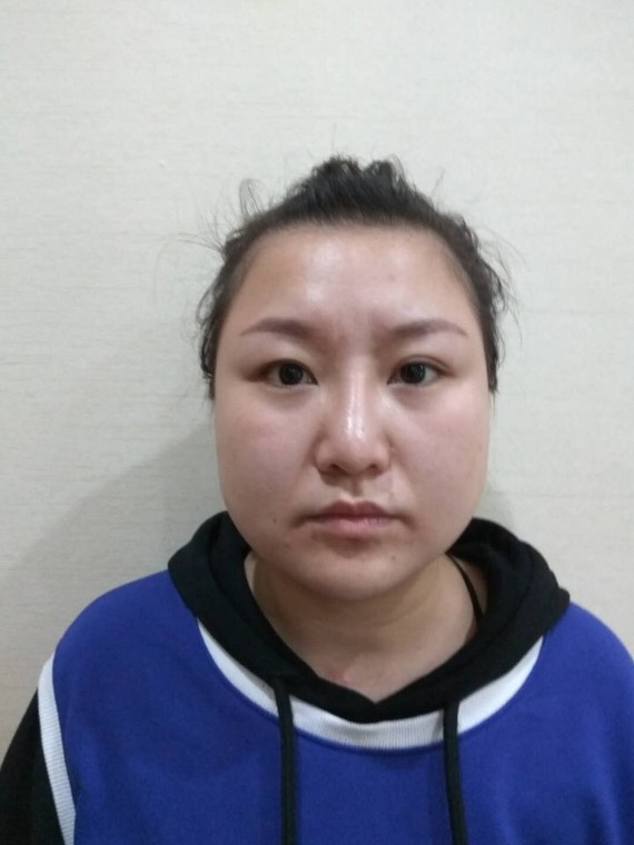 我脸上的肉真的特别多,照片就是我术前的样子