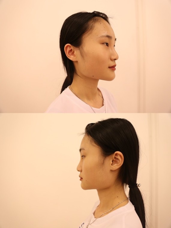 7715我是那种很明显脸宽的人,侧面衔接的地方差不多是_圈子-新氧