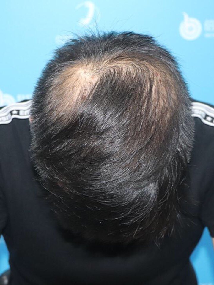 其实正面看起来,我头发挺浓密的,但是就偏偏头顶头发_圈子-新氧美容