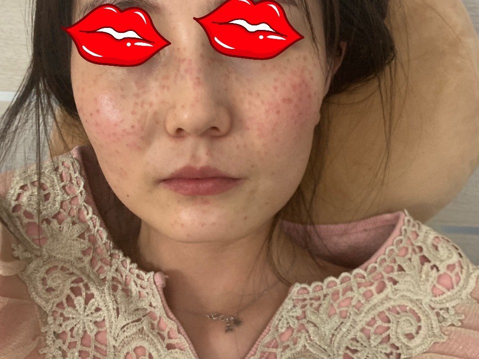 蜂巢皮秒祛斑