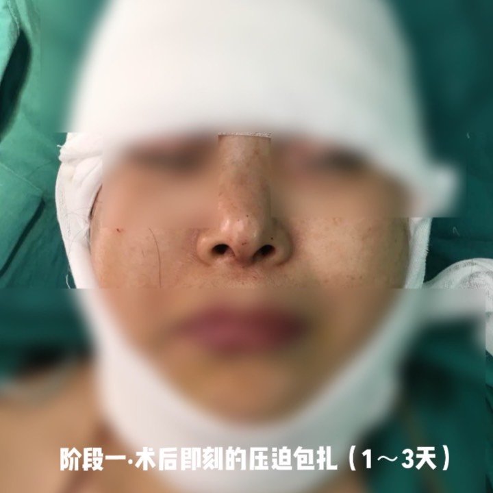 棉垫,绷带均匀地压迫包扎整个手术区域,将整个头部都包裹起来