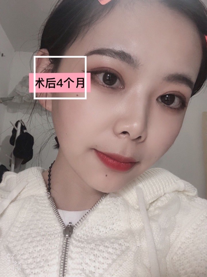 割了双眼皮,终于可以和肿眼泡说拜拜了!