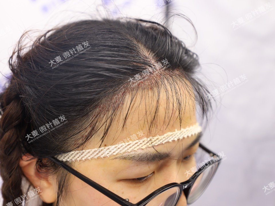20190605不剃发植发术后即刻