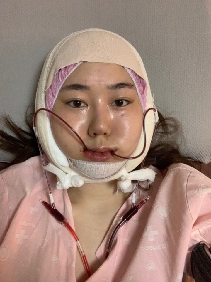 韩国卢钟勋整形医院下颌角缩小下巴缩小手术当天