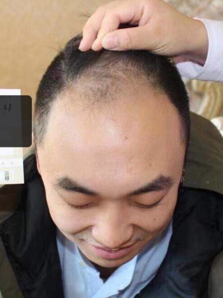 科发源微针植发 术后2年