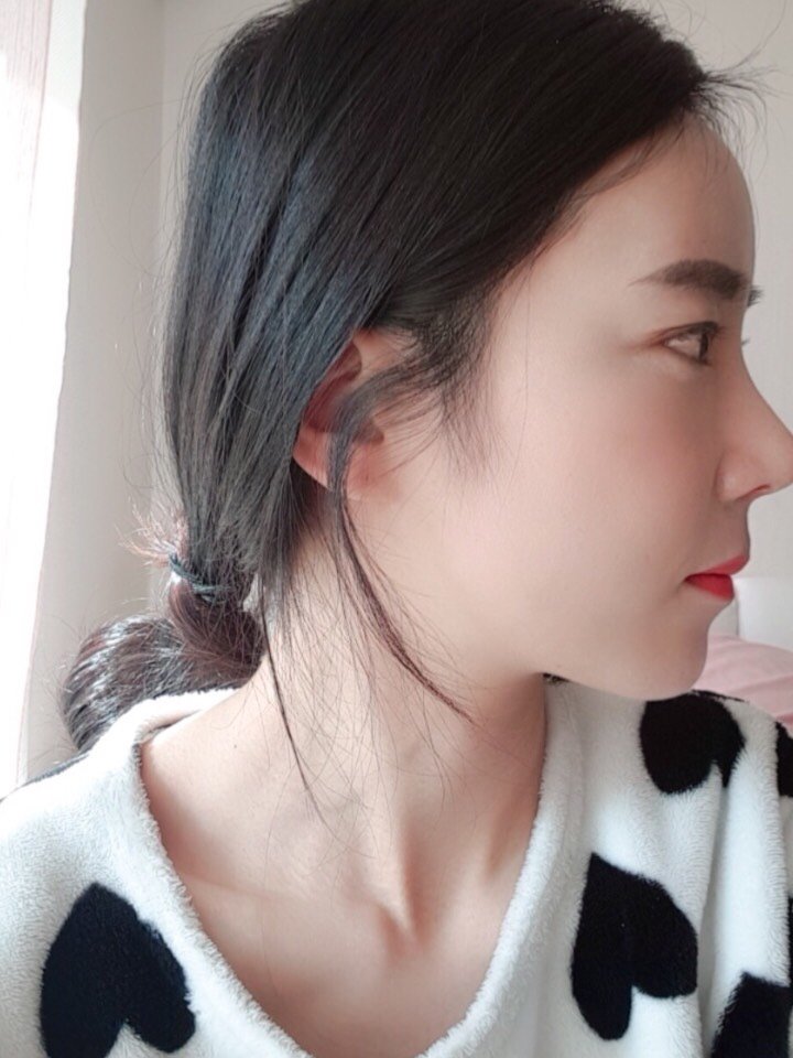 刚开始觉得鼻尖有点上翘了,那几天晚上睡觉都在想鼻子_圈子-新氧美容