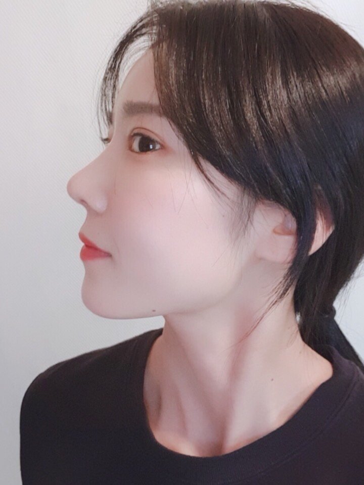 刚开始觉得鼻尖有点上翘了,那几天晚上睡觉都在想鼻子_圈子-新氧美容