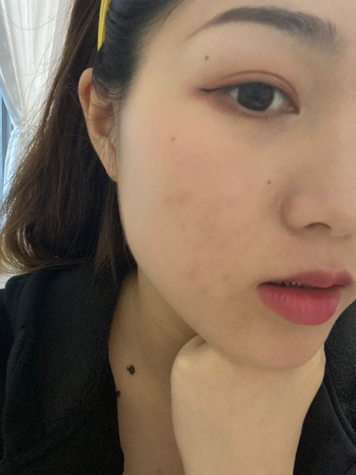 刷果酸鸡皮肤更严重了(鸡皮肤用了果酸更严重是怎么回事)