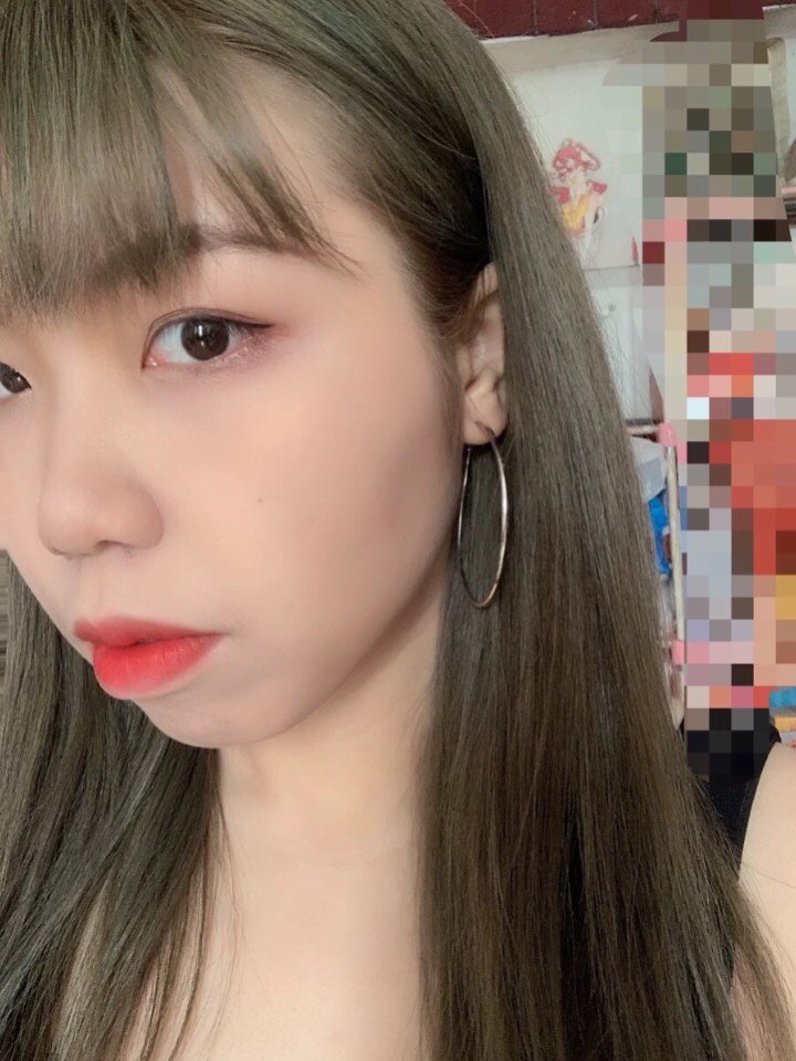 【埋线提升】长期逆龄 进口长效线 紧致提升除皱 线雕提升下面部