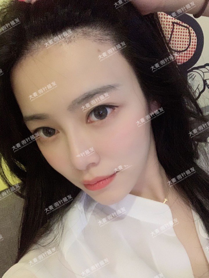 植发美女素材图(植发美女素材图片)