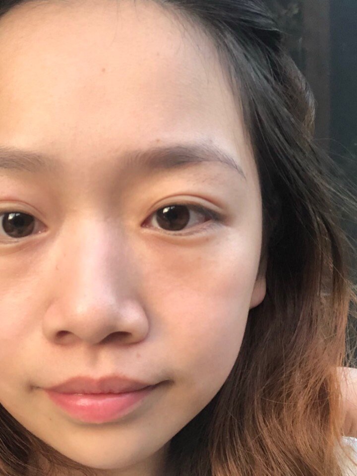 眼袋摘除手术太有必要!