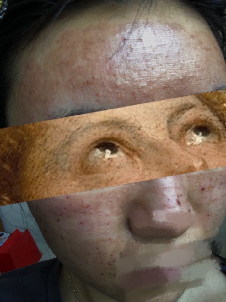 面部填充 后遗症图片