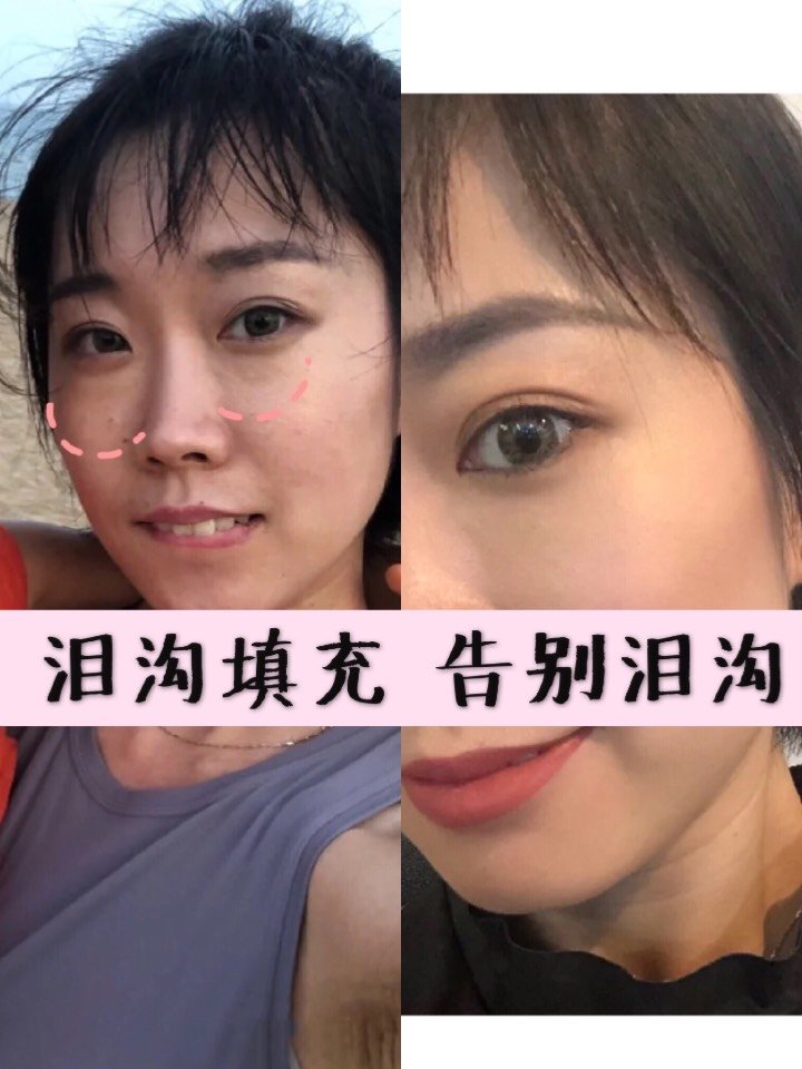 泪沟的形成和治疗