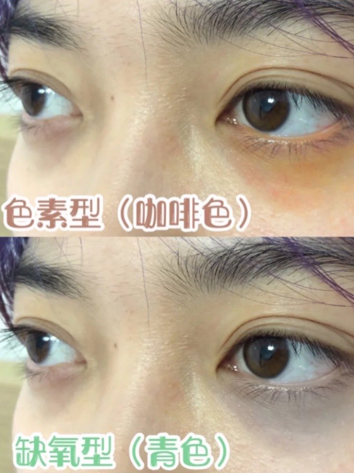 检测方法:扯平下眼睑后,皮肤会更薄,颜色会更明显,黑眼圈是青色
