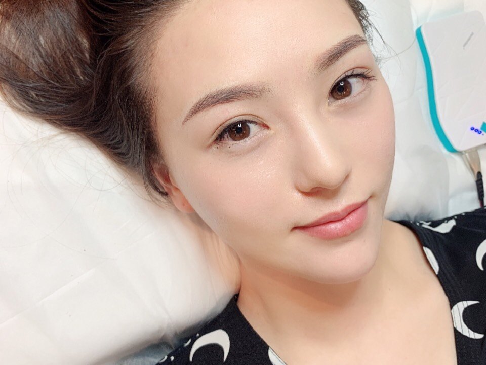 大家快看啊我发际线超级高是整体发_圈子-新氧美容整形