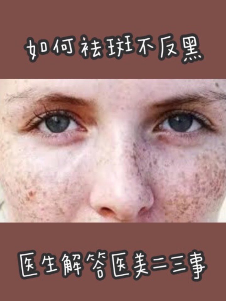 激光去斑後怕反黑?皮膚科醫生解答醫美常見問題