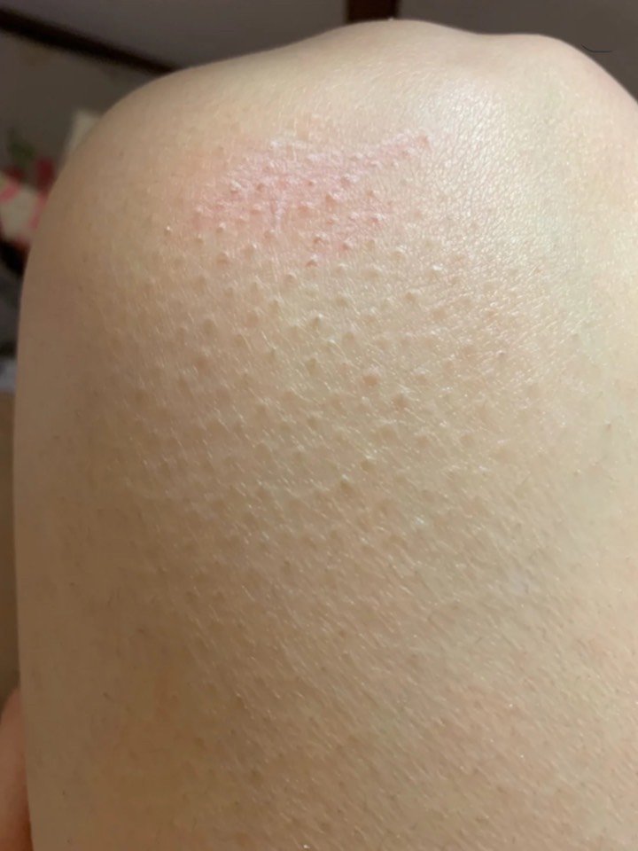 鸡皮肤到底能不能消失(鸡皮肤到底能不能消失呢)