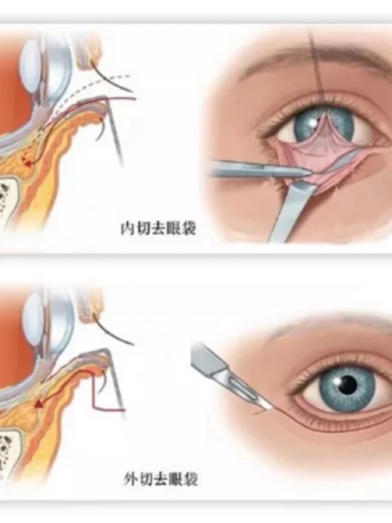 切眼袋会有后遗症