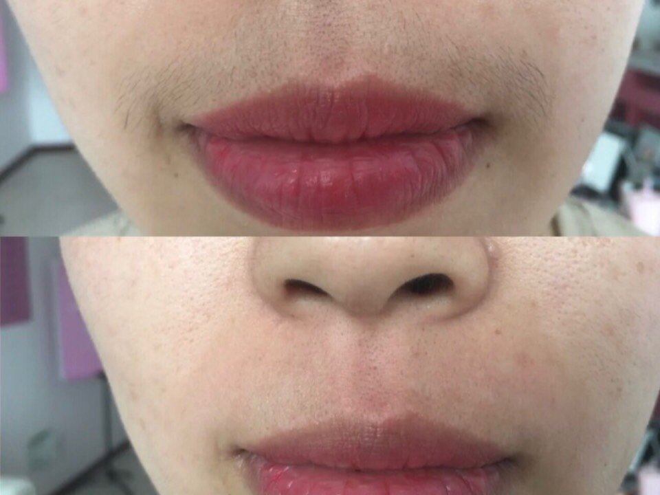 做了冰点脱唇毛,之前都是自己简单的刮了一下,这次就_圈子-新氧美容