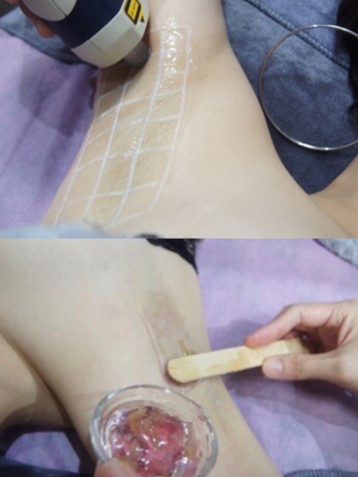 白白嫩嫩光滑无暇的腋下冰点脱毛!你get了嘛?