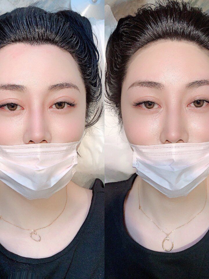 纹发际线真实反馈