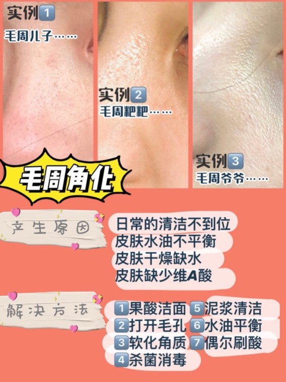 鸡皮疙瘩皮肤粗糙闭口(脸部皮肤很粗糙,全是小鸡皮疙瘩) 鸡皮疙瘩皮肤粗糙闭口(脸部皮肤很粗糙,全是小鸡皮疙瘩)