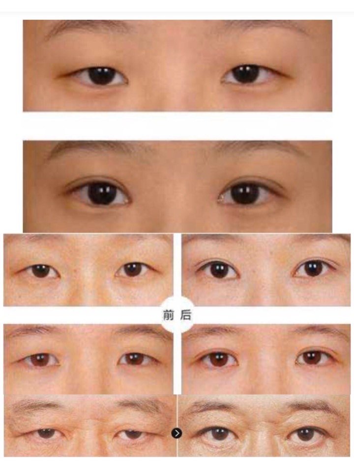 眼睛对一个人的颜值来讲非常重要,眼睛有神和无神给人_圈子-新氧美容