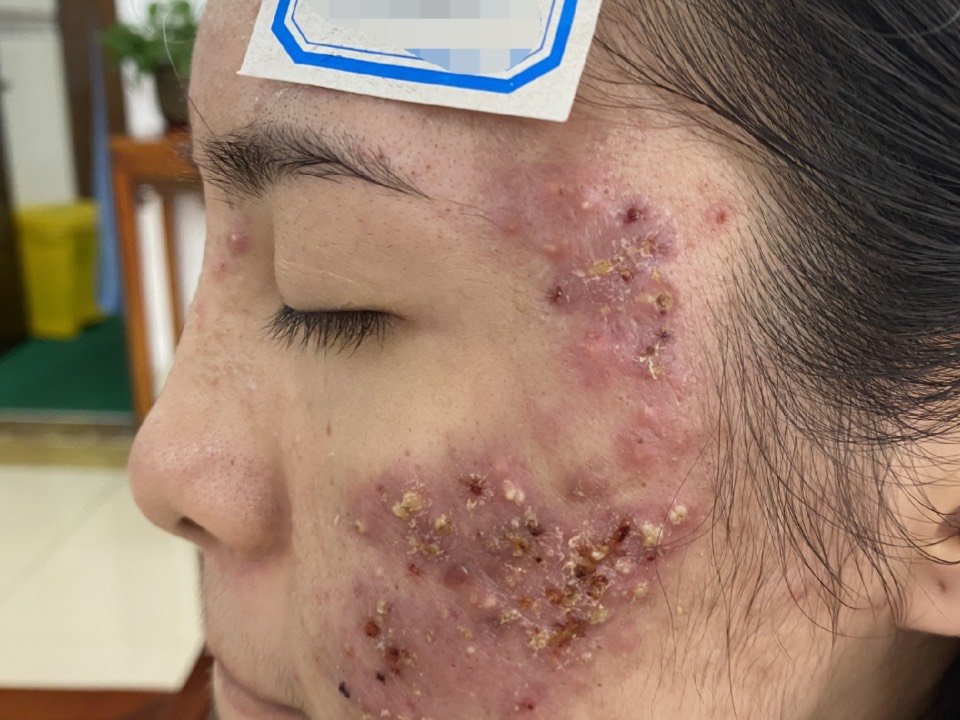 脸上痘痘很严重,一直都想做治疗又纠结,活了20多年_圈子-新氧美容整形