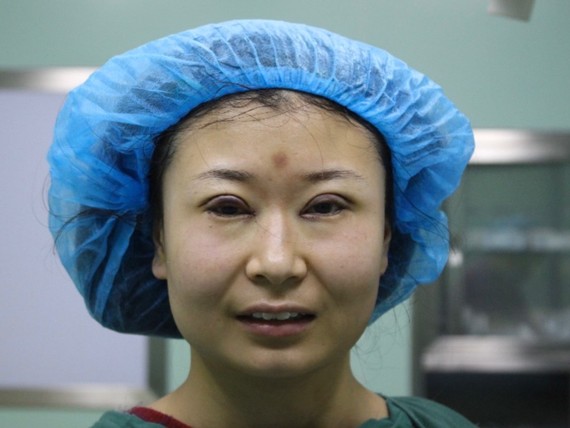 15眼部多项卢闯想着做个双眼皮就选择个好的,改_圈子-新氧美容整形