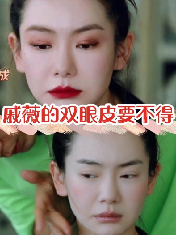 戚薇的双眼皮要不得,如何避免!