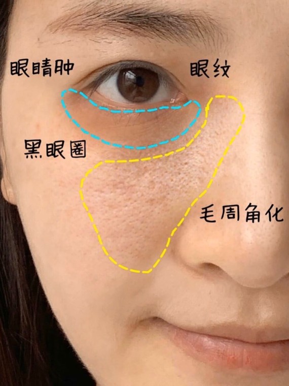 眼睛鼻子周围起鸡皮肤(眼睛鼻子周围起鸡皮肤怎么回事)