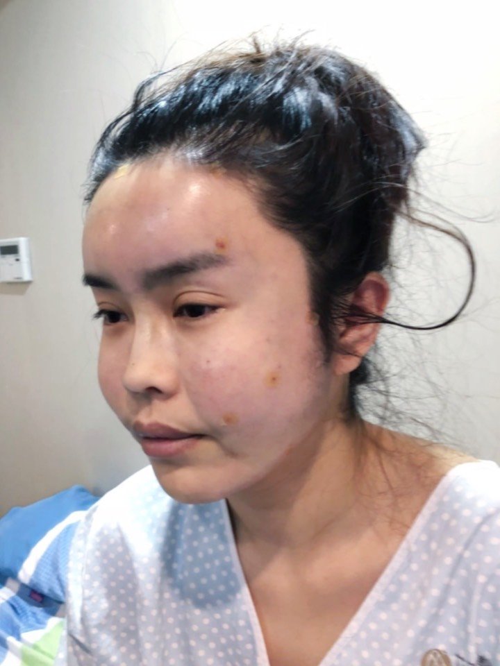 【自体脂肪填充饱满童颜术前术后即刻】