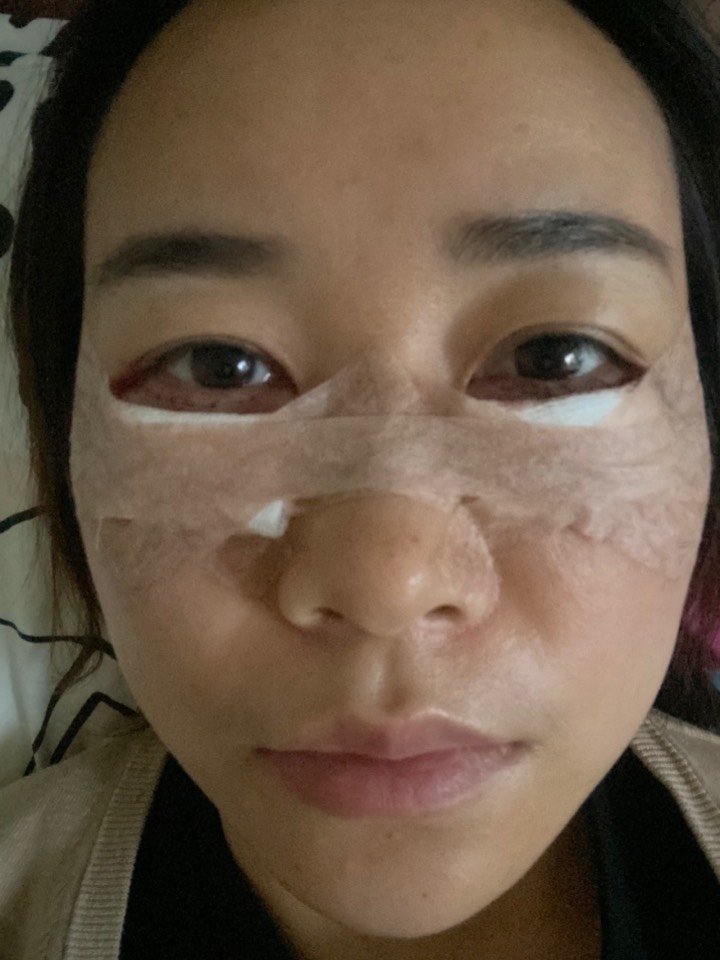 外切 眶隔释放第一天#眶膈释放 #外切眼袋_圈子-新氧美容整形