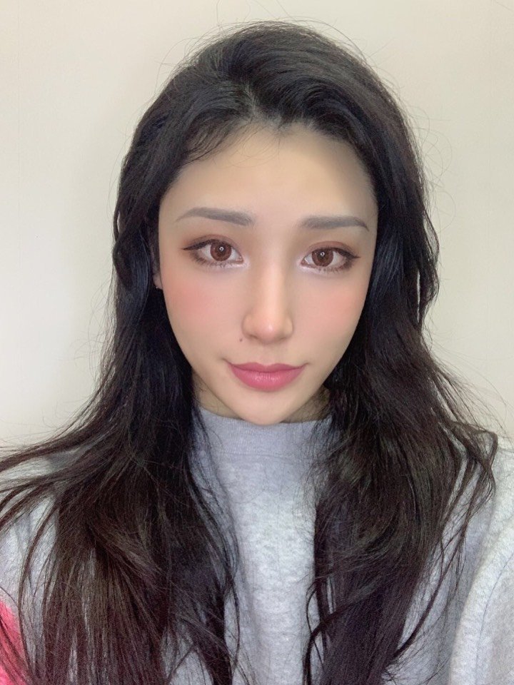 脂肪填充的魅力就在于让你的脸蛋更加精致,焕发童光,再加上高挺的鼻子