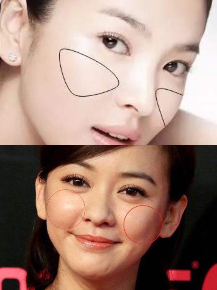 1玻尿酸填充苹果肌