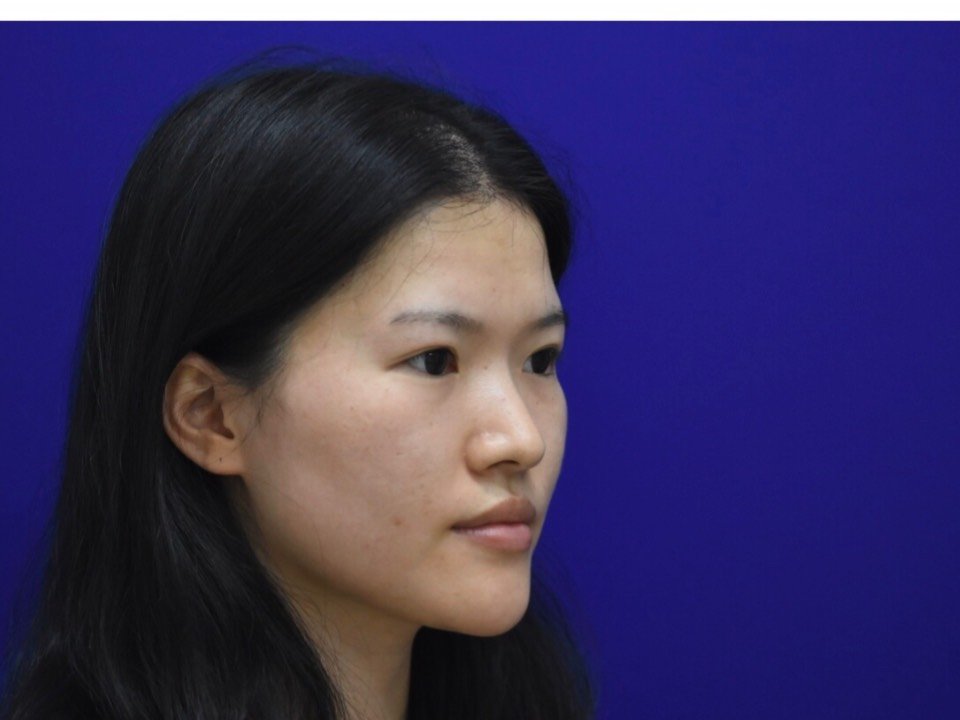 歪鼻矫正后还是歪的怎么办_鼻子有点歪矫正_歪鼻子矫正有风险吗