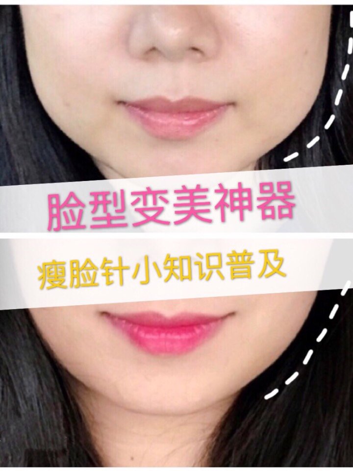 (敲重点)咬肌大的人去打瘦脸针才会有较为明显的效果.