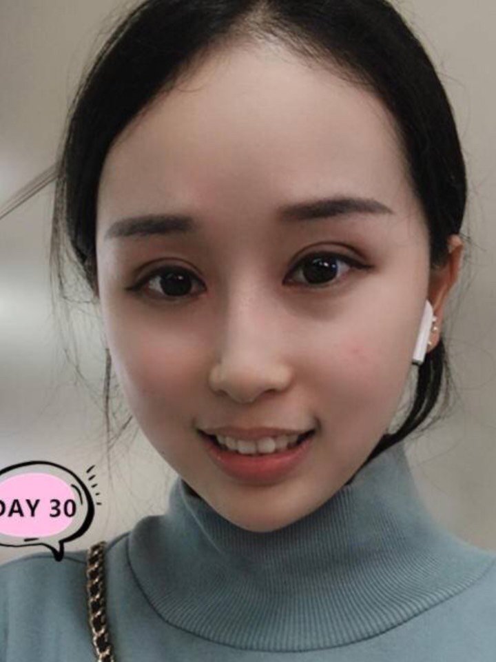 双眼皮通常都很薄,一般都是扇形或者内双, 因此不太适合做太宽的欧式