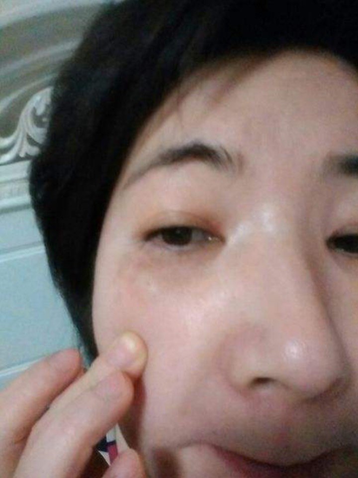 斑,特别是在颊部还有额头还有鼻子还有唇部还有颏部还有眶周还有颧部